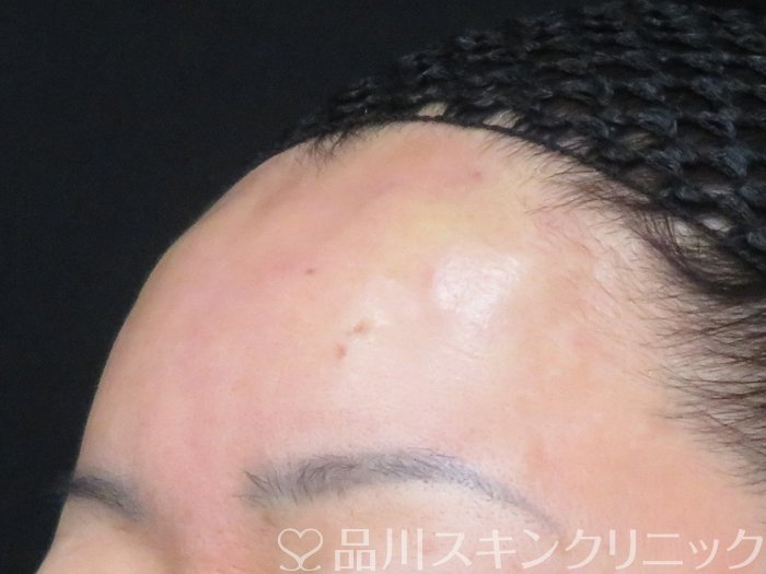 症例NO.69512のAFTER写真