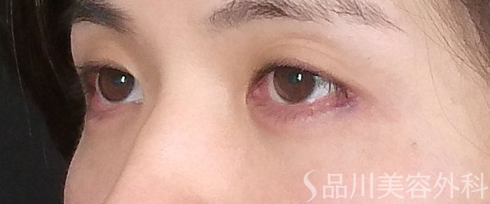 症例NO.72308のAFTER写真