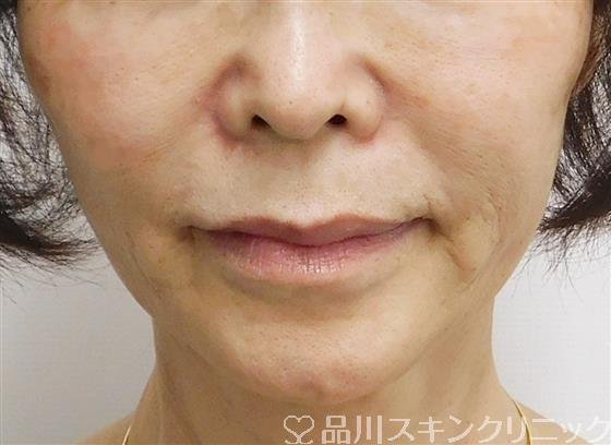 症例NO.56340のAFTER写真