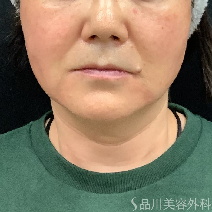 症例NO.75332のAFTER写真