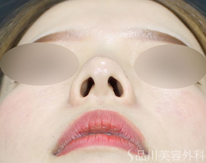 症例NO.71791のBEFORE写真