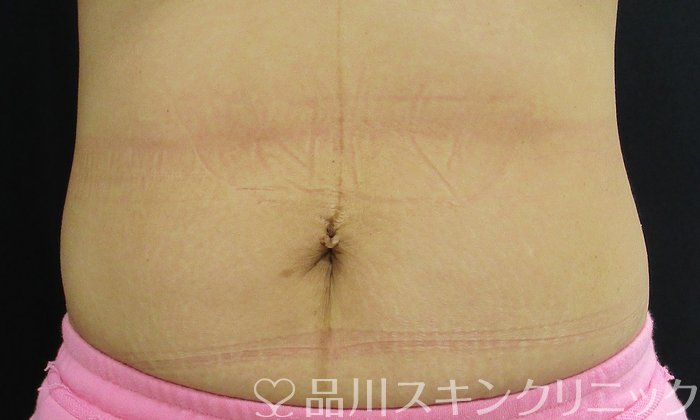 症例NO.74659のAFTER写真