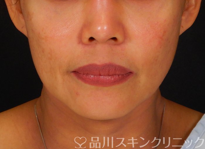 症例NO.66823のBEFORE写真