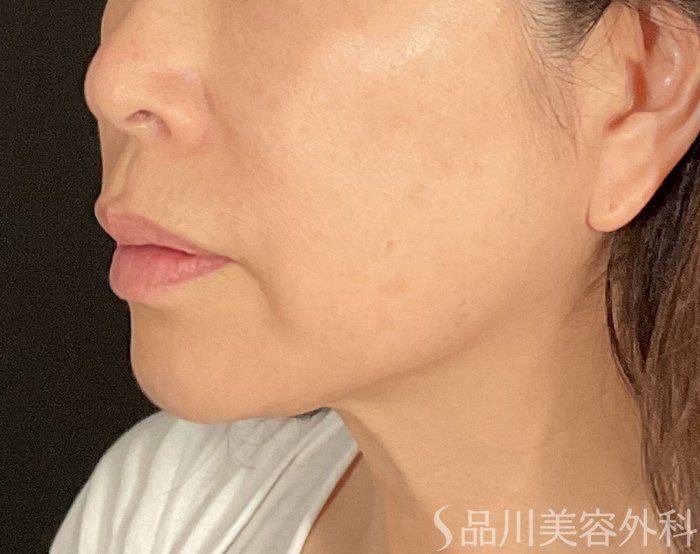 症例NO.74444のBEFORE写真