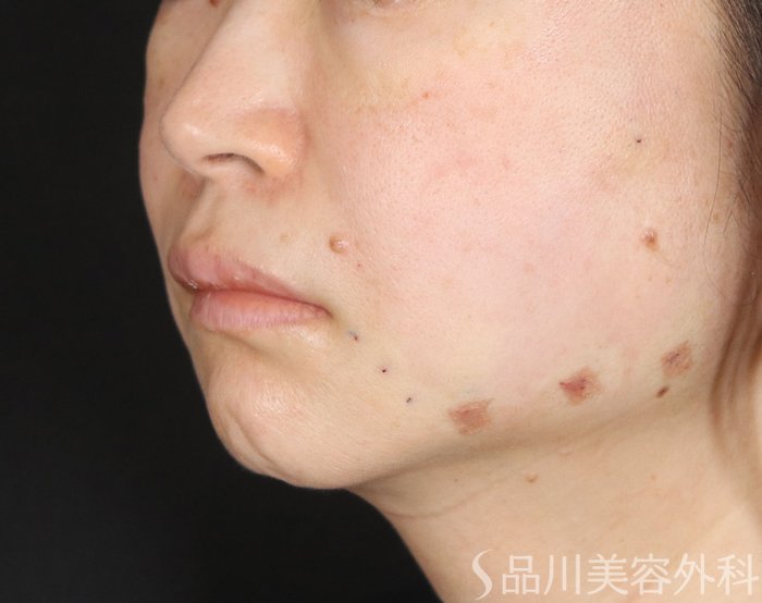 症例NO.73280のAFTER写真