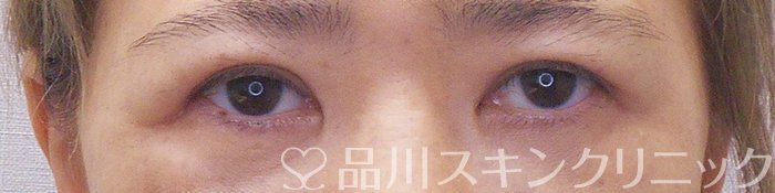 症例NO.70868のAFTER写真