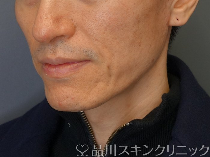 症例NO.72817のBEFORE写真