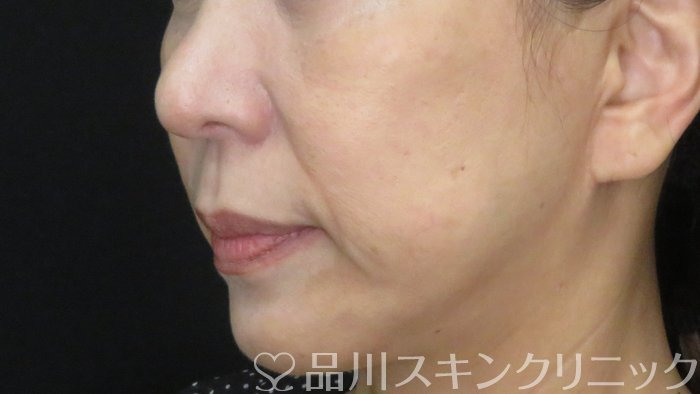 症例NO.72064のBEFORE写真