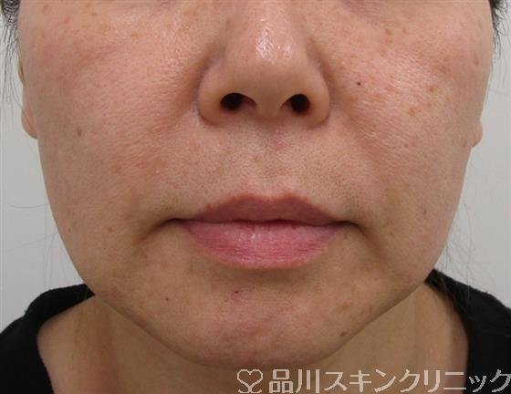 症例NO.41629のBEFORE写真