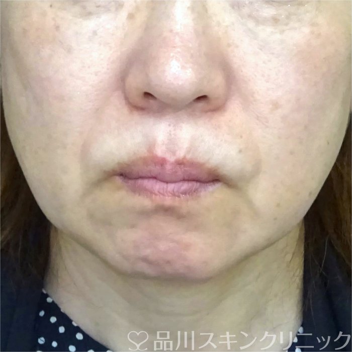 症例NO.69425のBEFORE写真