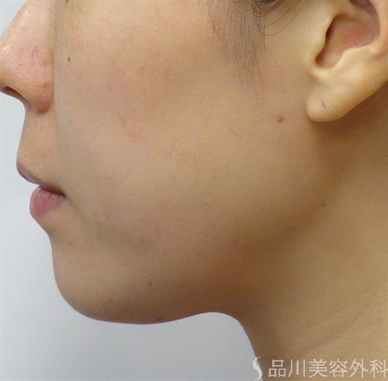 症例NO.47416のBEFORE写真