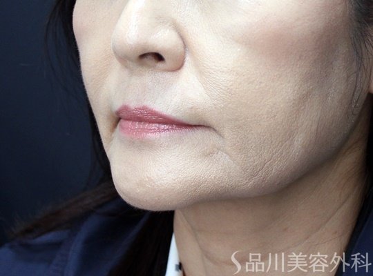 症例NO.70228のAFTER写真