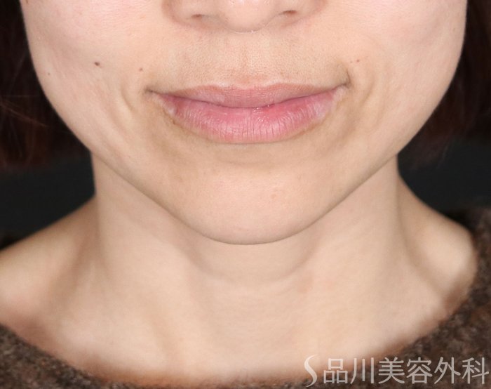 症例NO.72143のBEFORE写真