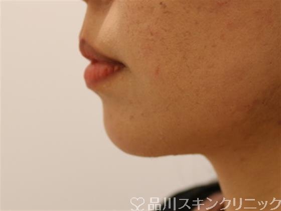 症例NO.43094のAFTER写真
