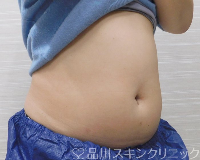 症例NO.67733のBEFORE写真
