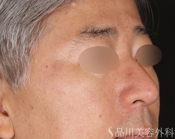 症例NO.71814のAFTER写真