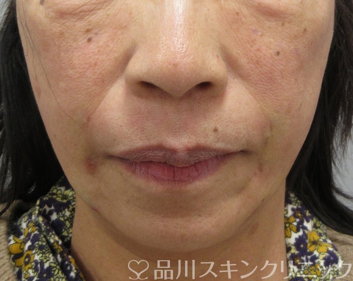 症例NO.75331のAFTER写真