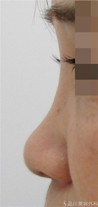 症例NO.44025のBEFORE写真
