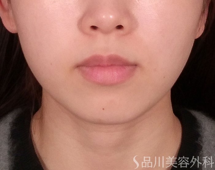 症例NO.69328のBEFORE写真