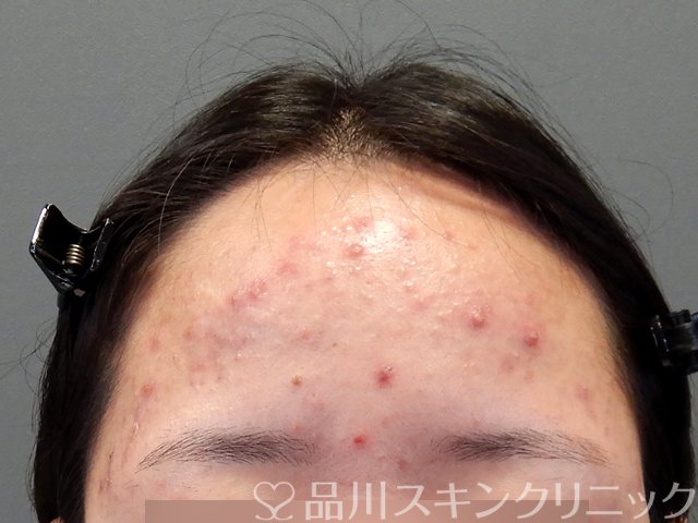 症例NO.69797のBEFORE写真