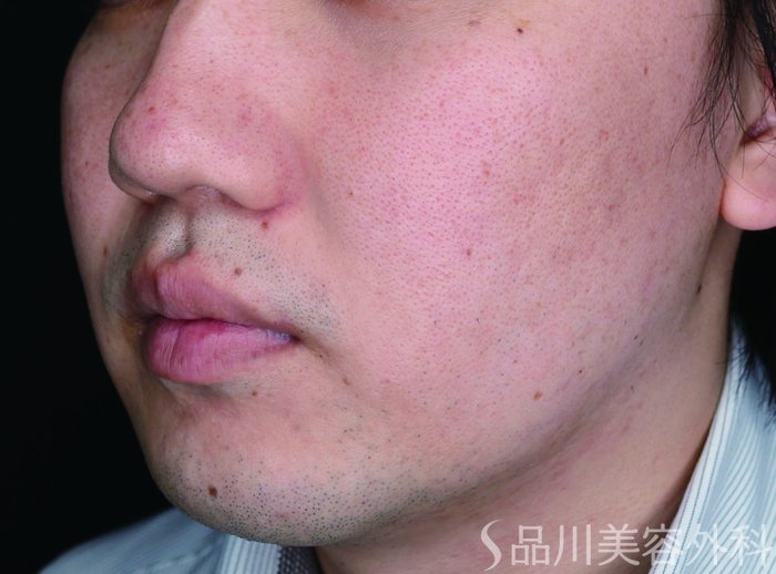 症例NO.71300のAFTER写真