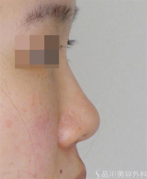 症例NO.51249のBEFORE写真