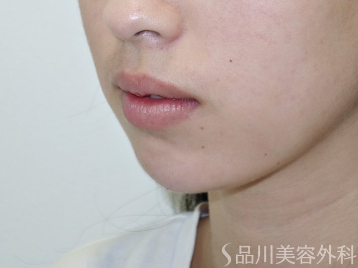 症例NO.69528のAFTER写真