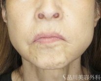 症例NO.75300のBEFORE写真