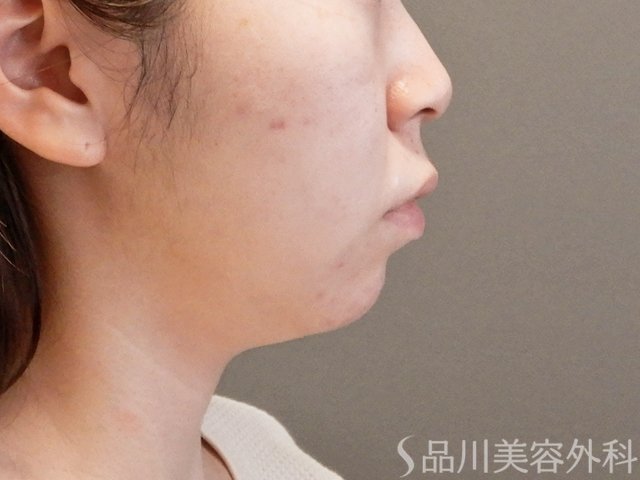 症例NO.64010のBEFORE写真