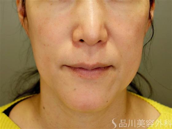 症例NO.50138のBEFORE写真