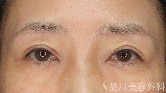 症例NO.72132のAFTER写真