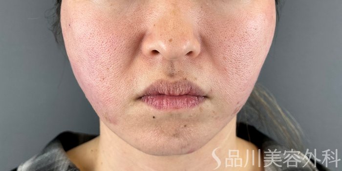 症例NO.73010のAFTER写真