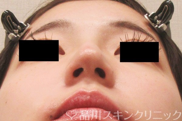 症例NO.69564のAFTER写真