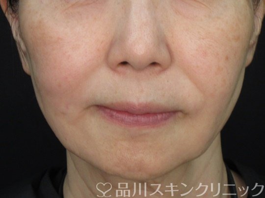 症例NO.73650のAFTER写真