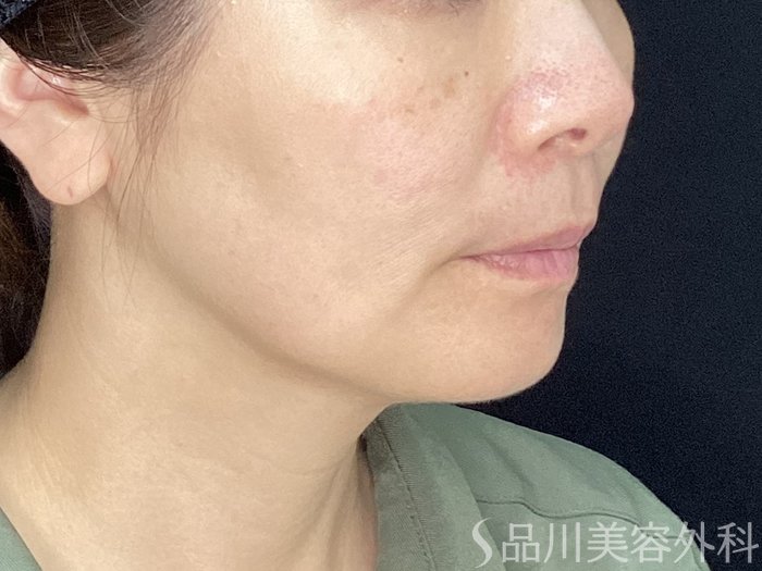 症例NO.71886のBEFORE写真