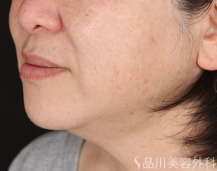 症例NO.73730のBEFORE写真