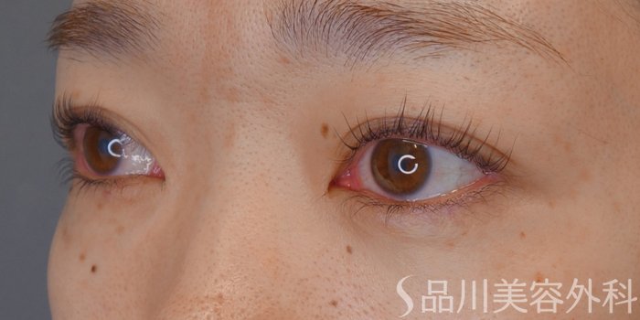 症例NO.73329のAFTER写真