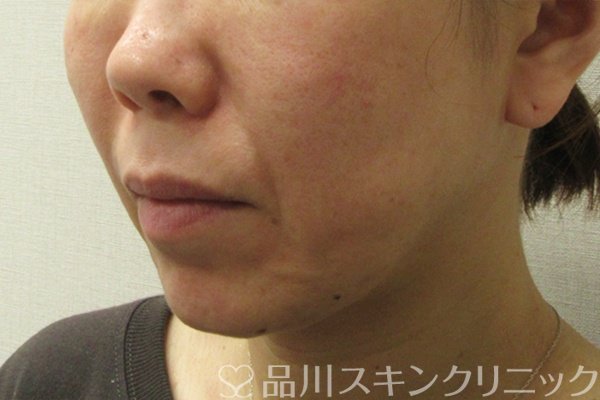 症例NO.75110のBEFORE写真