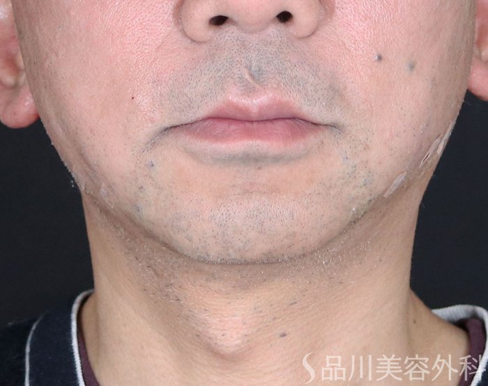 症例NO.73477のAFTER写真