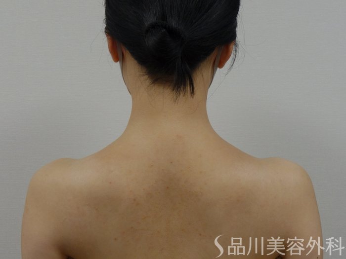 症例NO.73667のAFTER写真