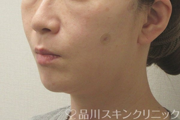 症例NO.74556のAFTER写真