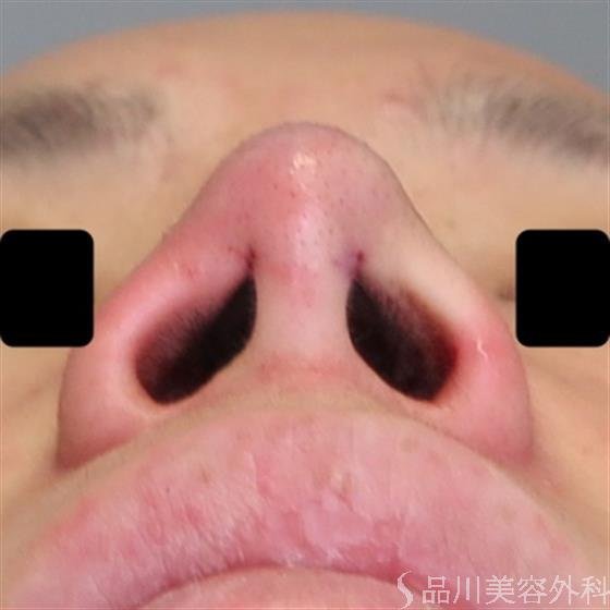 症例NO.48251のAFTER写真