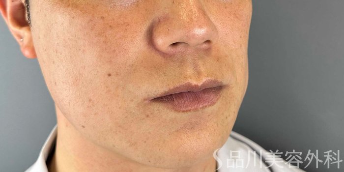 症例NO.68200のBEFORE写真