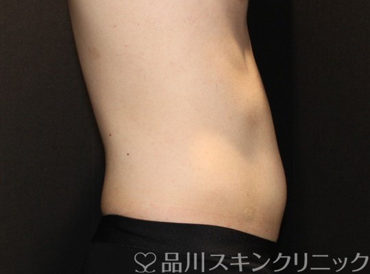 症例NO.72098のAFTER写真