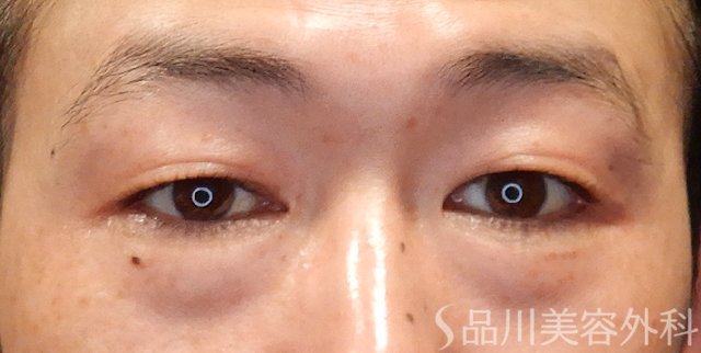 症例NO.74435のBEFORE写真