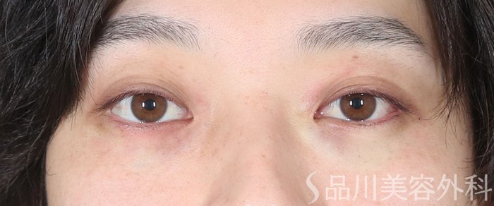 症例NO.73562のAFTER写真