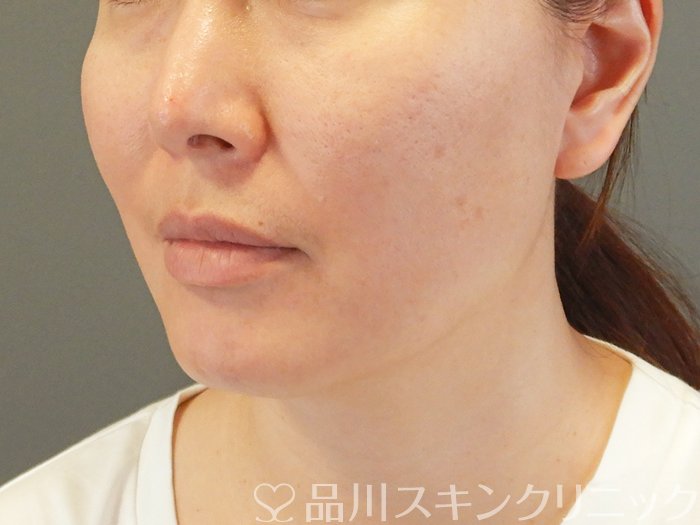 症例NO.65379のBEFORE写真