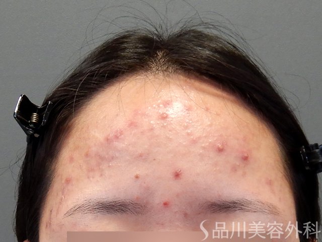 症例NO.69797のBEFORE写真