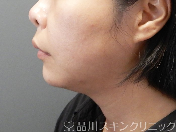 症例NO.72381のAFTER写真