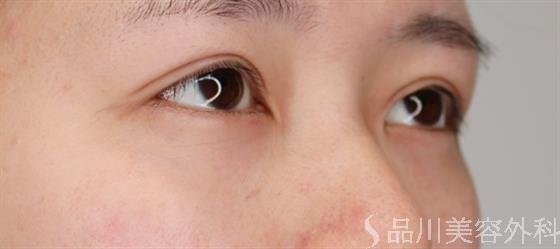 症例NO.50624のAFTER写真